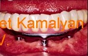 Имплантация зубов и фиксация на шаровидных аббатментах Имплантация зубов и фиксация на шаровидных аббатментах