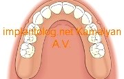 фиксация с помощью балочной конструкции фиксация с помощью балочной конструкции