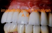 Имплантация зубов и фиксация с помощью усиленной армированной конструкции Имплантация зубов и фиксация с помощью усиленной армированной конструкции