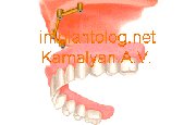 фиксация с помощью балочной конструкции фиксация с помощью балочной конструкции